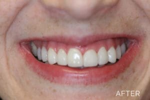 Patient's smile after dentistry services by Donald G. Guebert, DMD