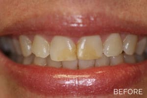 Teeth whitening before