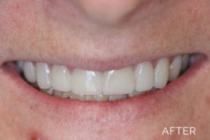 Cosmetic dentistry after
