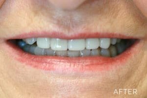Teeth correction after