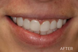 Overbite correction after