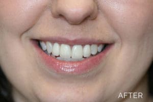 Donald G. Guebert, DMD patient after cosmetic dentistry