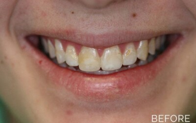 Donald G. Guebert, DMD patient before teeth whitening