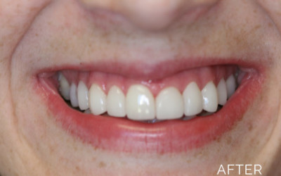 Patient's smile after dentistry services by Donald G. Guebert, DMD