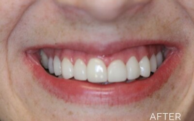 Patient's smile after dentistry services by Donald G. Guebert, DMD