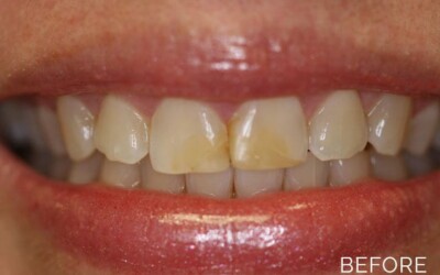 Teeth whitening before