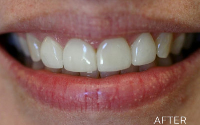 Teeth whitening after