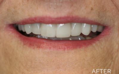 Smile gallery after