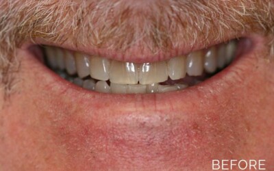 Dental veneers before