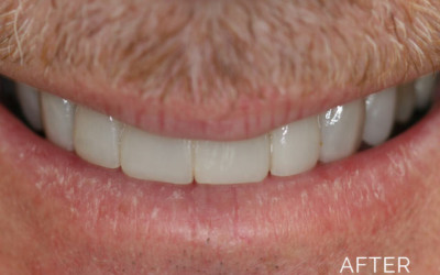 Dental veneers after