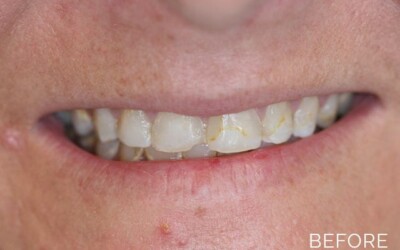 Cosmetic dentistry before