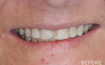 Cosmetic dentistry before