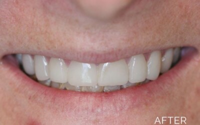 Cosmetic dentistry after
