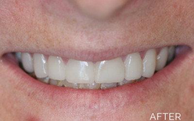 Cosmetic dentistry after