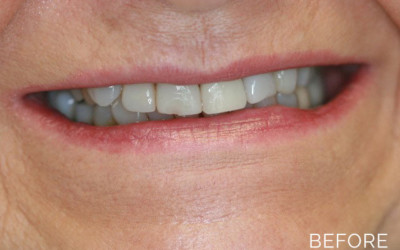 Teeth correction before