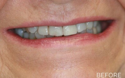 Teeth correction before