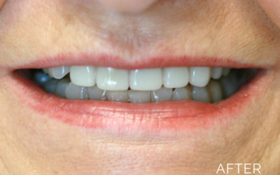Teeth correction after