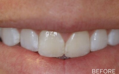 Overbite correction before