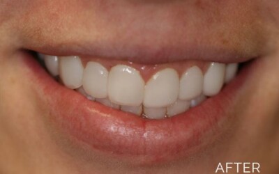 Overbite correction after
