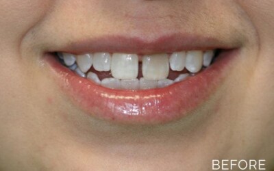 Donald G. Guebert, DMD patient before cosmetic dentistry