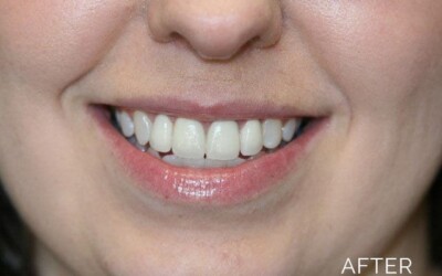 Donald G. Guebert, DMD patient after cosmetic dentistry