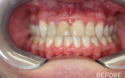 Donald G. Guebert, DMD patient before smile makeover