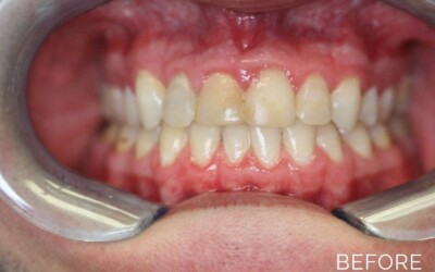 Donald G. Guebert, DMD patient before smile makeover