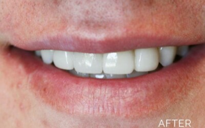 Donald G. Guebert, DMD patient after smile makeover