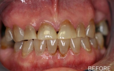 Donald G. Guebert, DMD patient before veneers