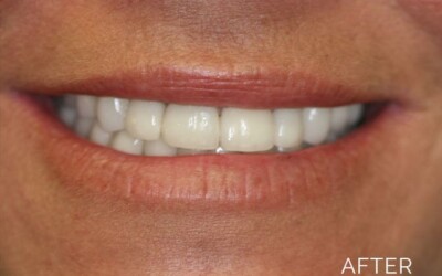 Donald G. Guebert, DMD patient after veneers