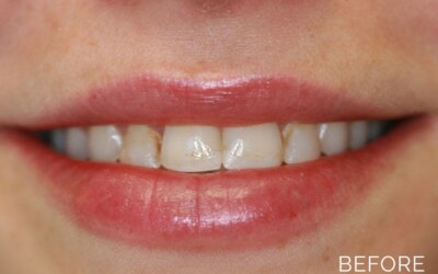 Donald G. Guebert, DMD patient before teeth correction