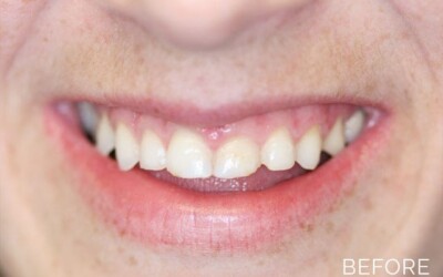 Patient's smile before dentistry services by Donald G. Guebert, DMD